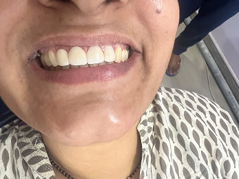 Dental before and after result 1 - after