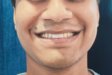Dental before and after result 2 - after