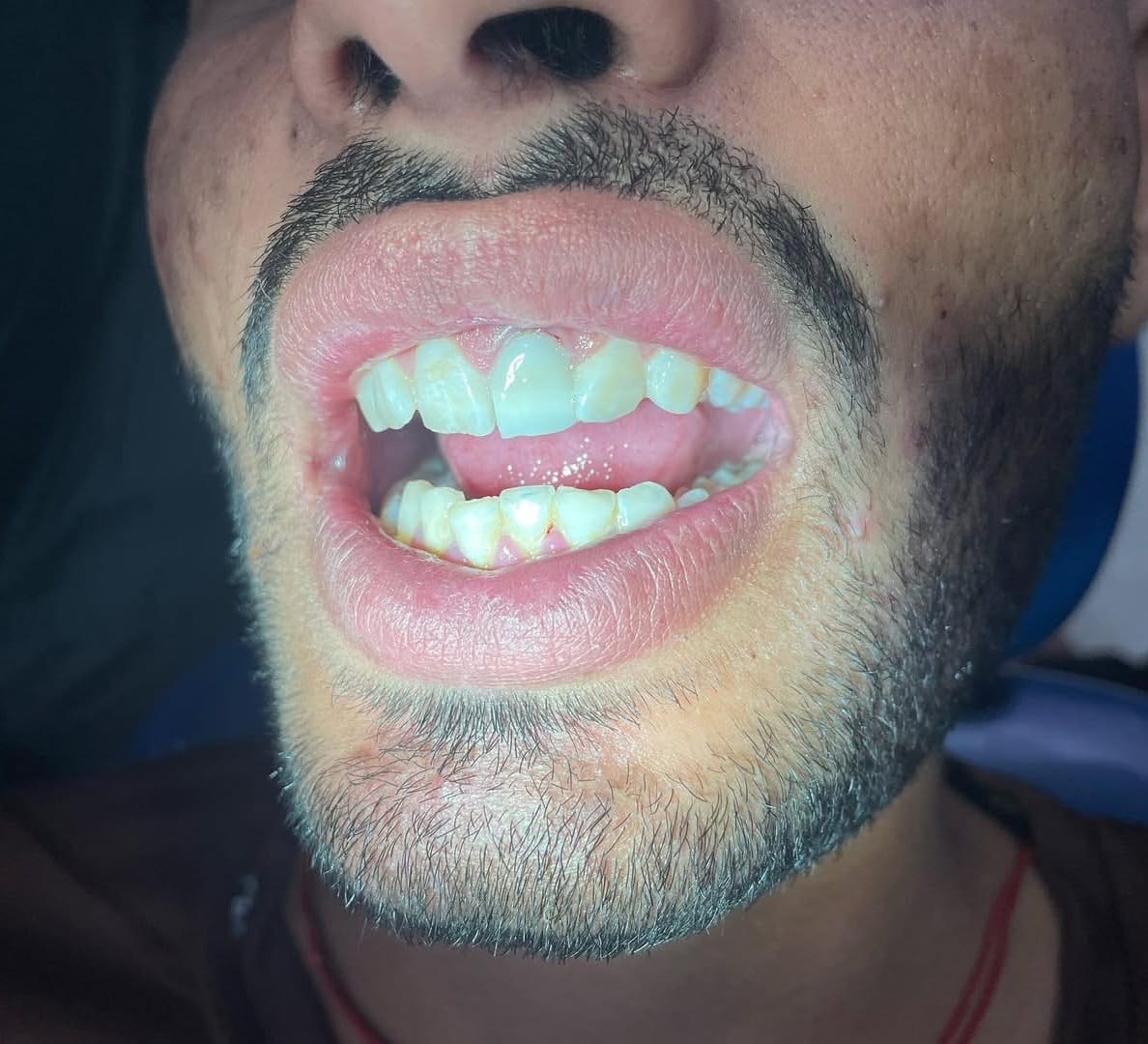 Dental before and after result 3 - after