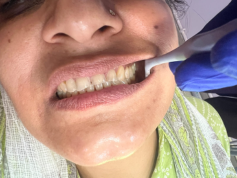 Dental before and after result 1 - before