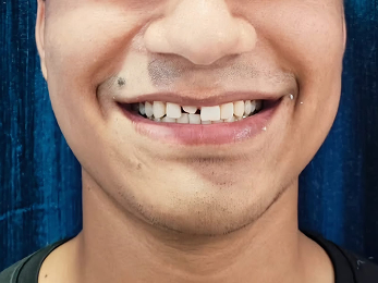 Dental before and after result 2 - before