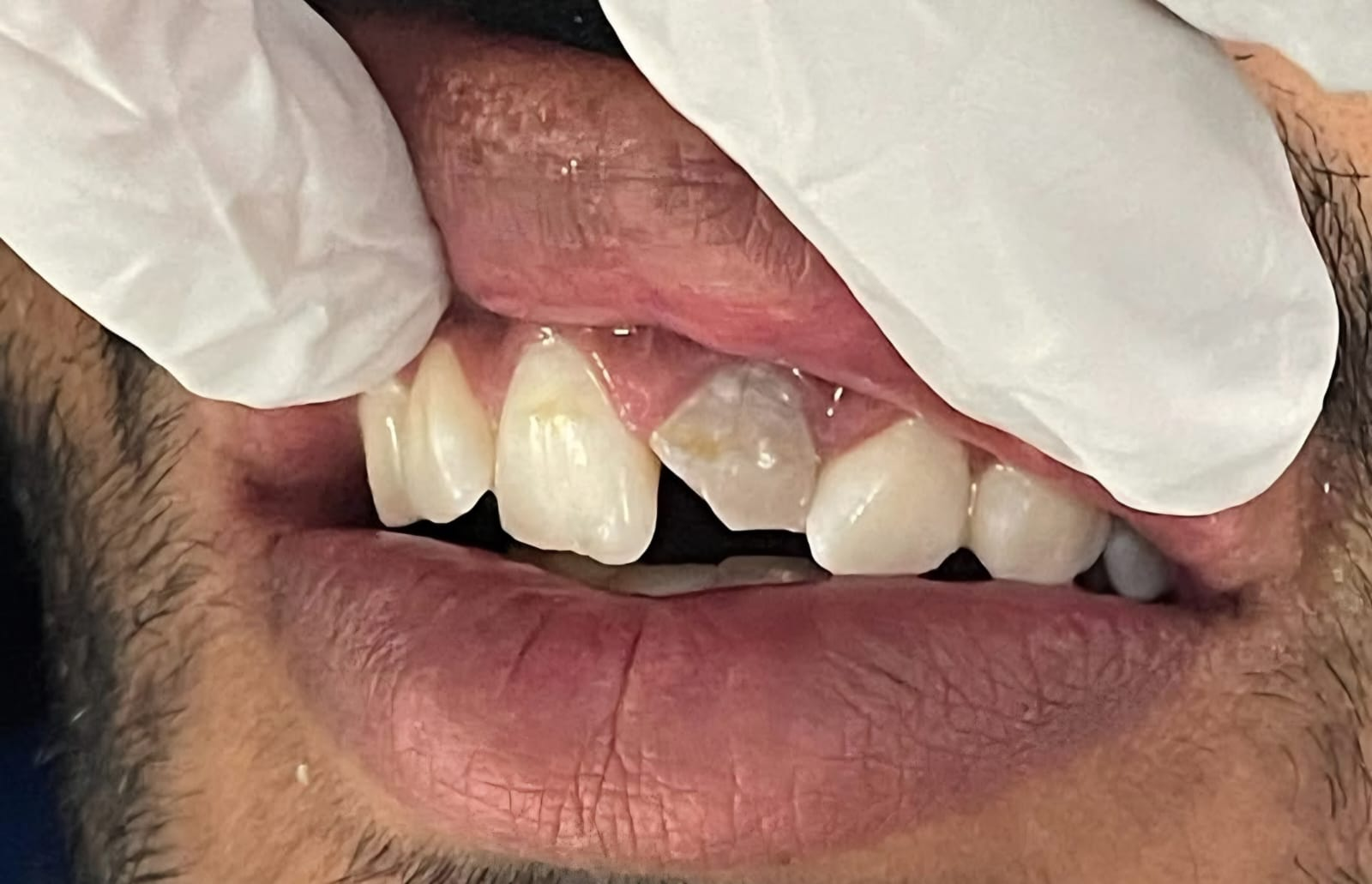 Dental before and after result 3 - before