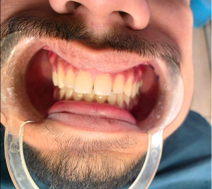 Dental procedure