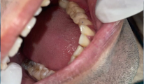 Dental treatment